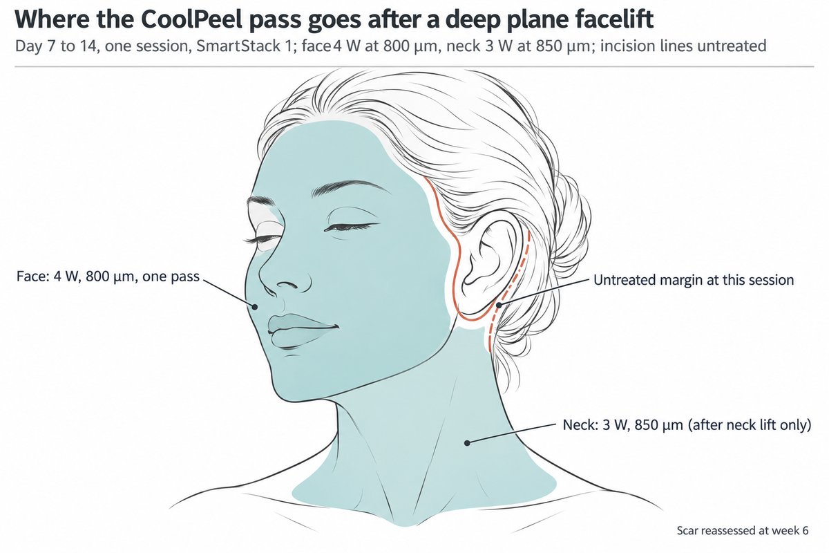 Schéma d’un visage de trois quarts montrant les zones de traitement CoolPeel après un lifting deep plane : le visage entier ombré en sarcelle sourde à 4 watts et 800 micromètres d’espacement, le cou ombré en sarcelle plus claire à 3 watts et 850 micromètres d’espacement, et les lignes d’incision prétragienne, rétro-auriculaire et temporale dessinées en terracotta avec une marge non traitée nette de part et d’autre, ces lignes étiquetées « non lasérées à cette séance ».