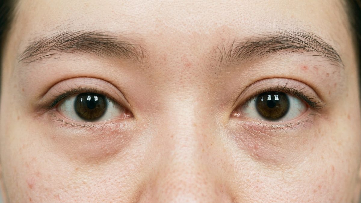 Asymmetric double eyelid crease showing early signs of loosening and unfolding after blepharoplasty