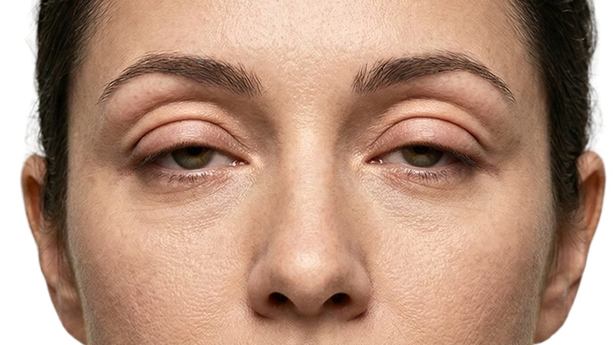 The Anatomy of Double Eyelid Revision: Solving 'Sausage Eyes' and Unfolding Creases