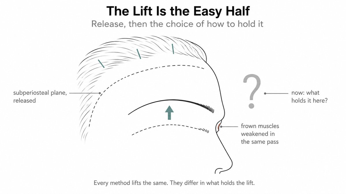 Side view of a forehead lifted upward through hidden scalp incisions after release in the subperiosteal plane, with the frown muscles weakened, and a question mark asking what will hold the lift in place.