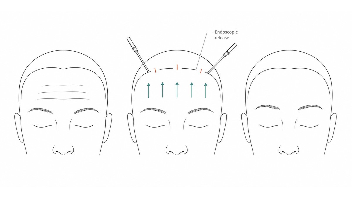 Forehead Lift Fixation: Endotine, Bone Tunnel, or Deep-Tissue Suture?