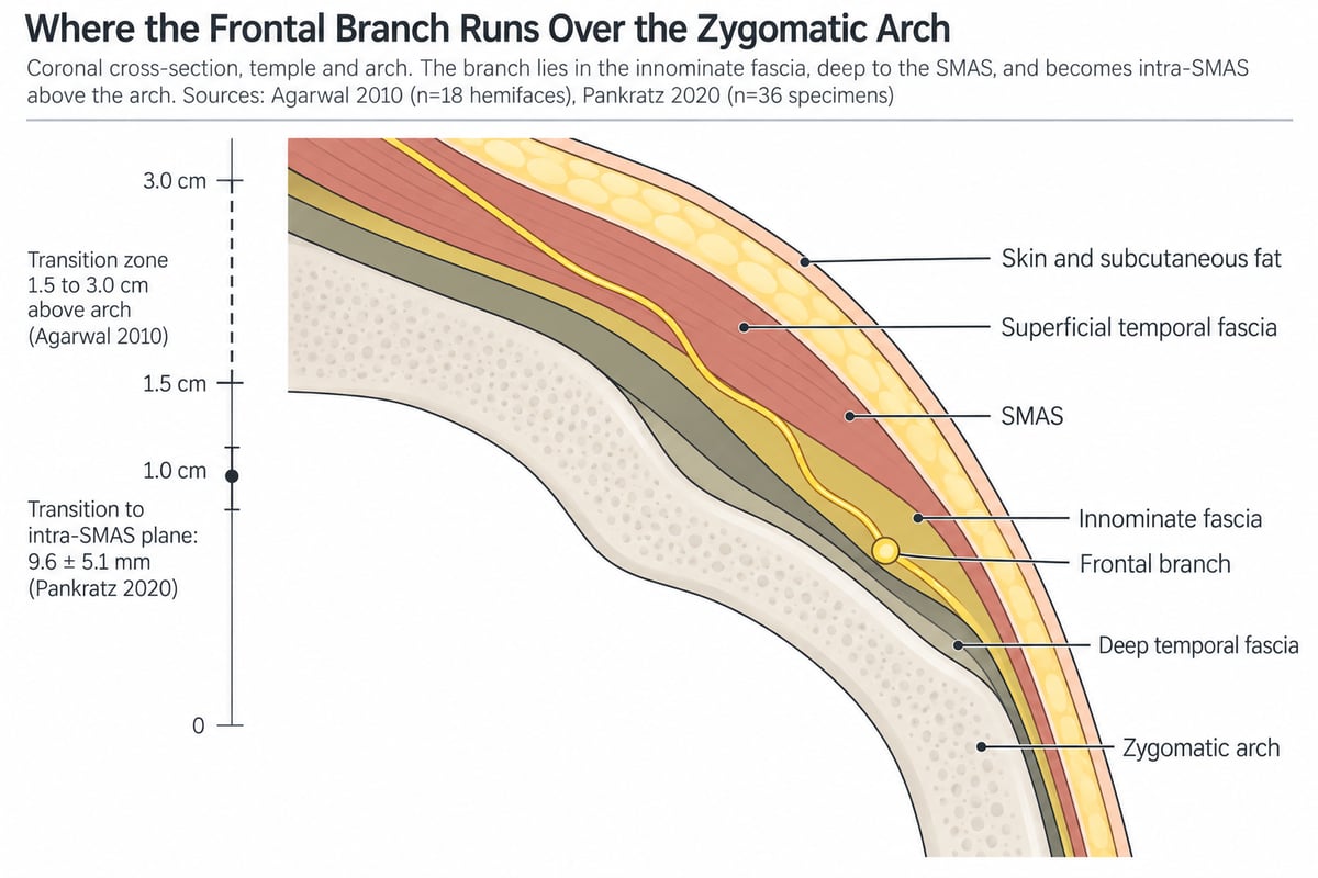 Coronal cross-section through the temple and the zygomatic arch, layers stacked from skin and subcutaneous fat through the SMAS continuous with the superficial temporal fascia, a distinct innominate fascia band deep to them carrying the frontal branch as a gold circle at arch level, then the deep temporal fascia and the arch in section, with the transition to an intra-SMAS plane marked twice and never averaged, at 9.6 plus or minus 5.1 mm and as a dashed band 1.5 to 3.0 cm above the arch.