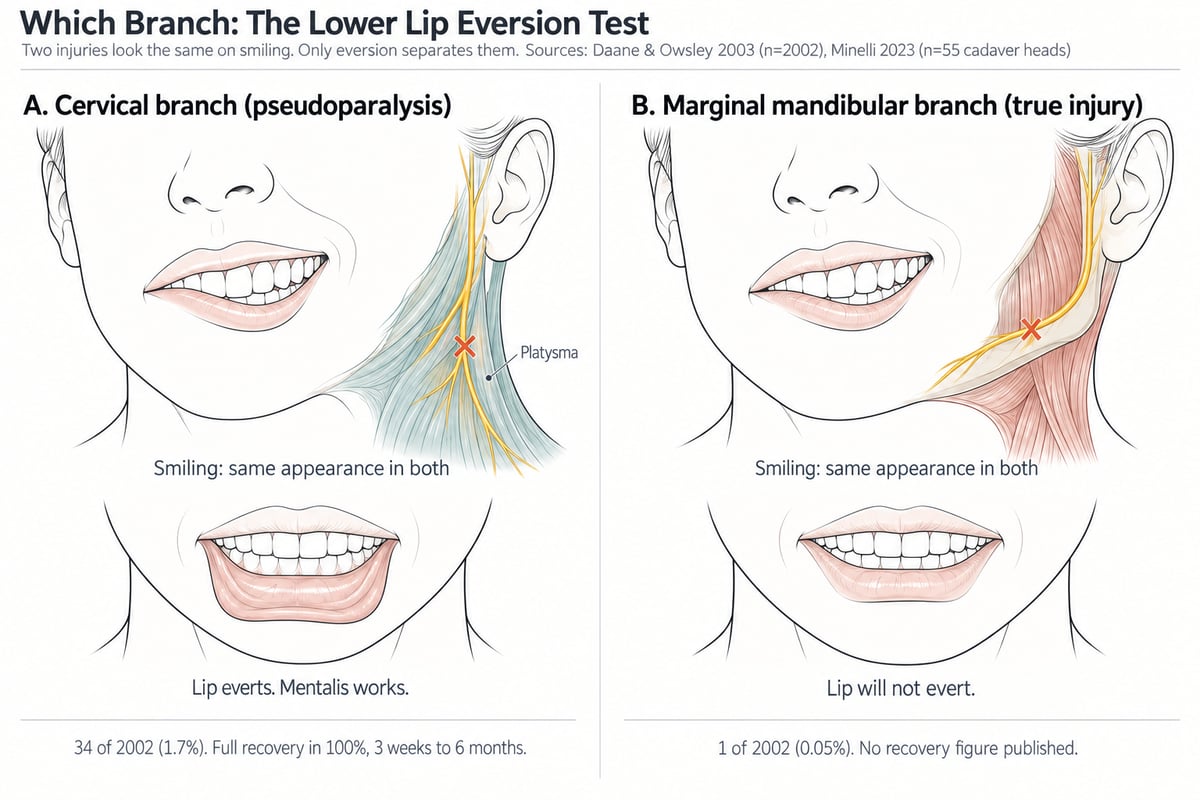 Two-panel diagram of the lower lip eversion test after a facelift. Panel A marks an injured cervical branch running beneath the platysma, with the same asymmetric smile as panel B and a lower lip that still everts because the mentalis works, 34 of 2002 cases and full recovery in every one within 3 weeks to 6 months. Panel B marks an injured marginal mandibular branch running forward along the jawline over the lip depressor muscles, with a lower lip that will not evert, 1 of 2002 cases and no published recovery figure.