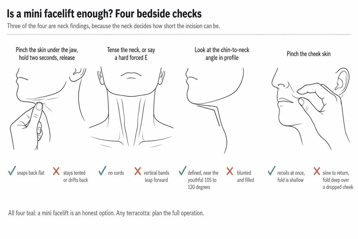 Four bedside checks that decide whether a mini facelift is enough, drawn in a row: pinching the skin under the jaw and watching whether it snaps back, tensing the neck to see whether vertical platysmal bands leap forward, reading the angle where the underside of the chin meets the neck in profile, and pinching the cheek skin to judge its recoil beside the nasolabial fold. Each check is marked with the finding that keeps a mini facelift on the table and the finding that moves the patient to a full facelift.