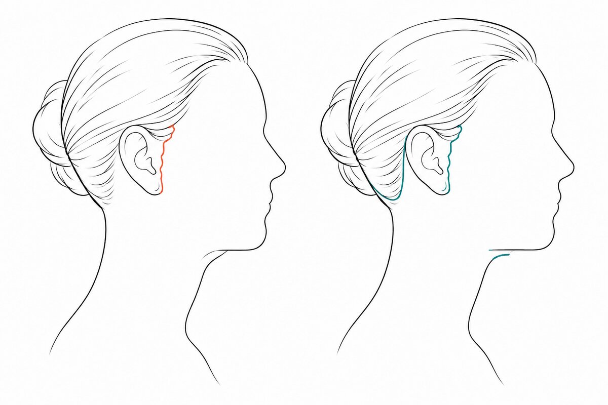 Mini Facelift vs. Full Facelift: What the Word Mini Actually Leaves Out