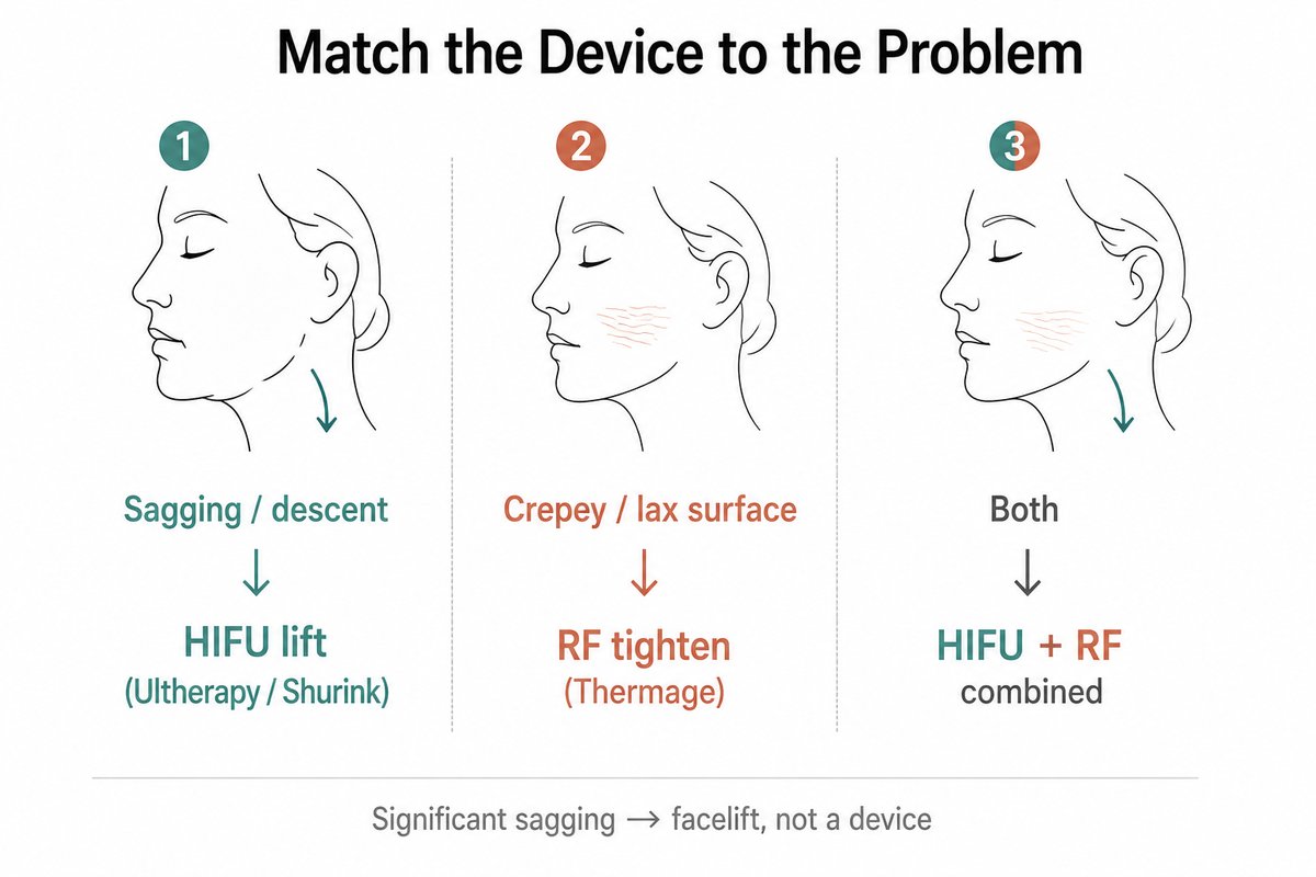 Decision chart matching skin concerns to treatments: sagging or descent to HIFU lifting with Ultherapy or Shurink, crepey or lax surface to radiofrequency tightening with Thermage, and both to a combination, noting significant sagging needs a facelift.