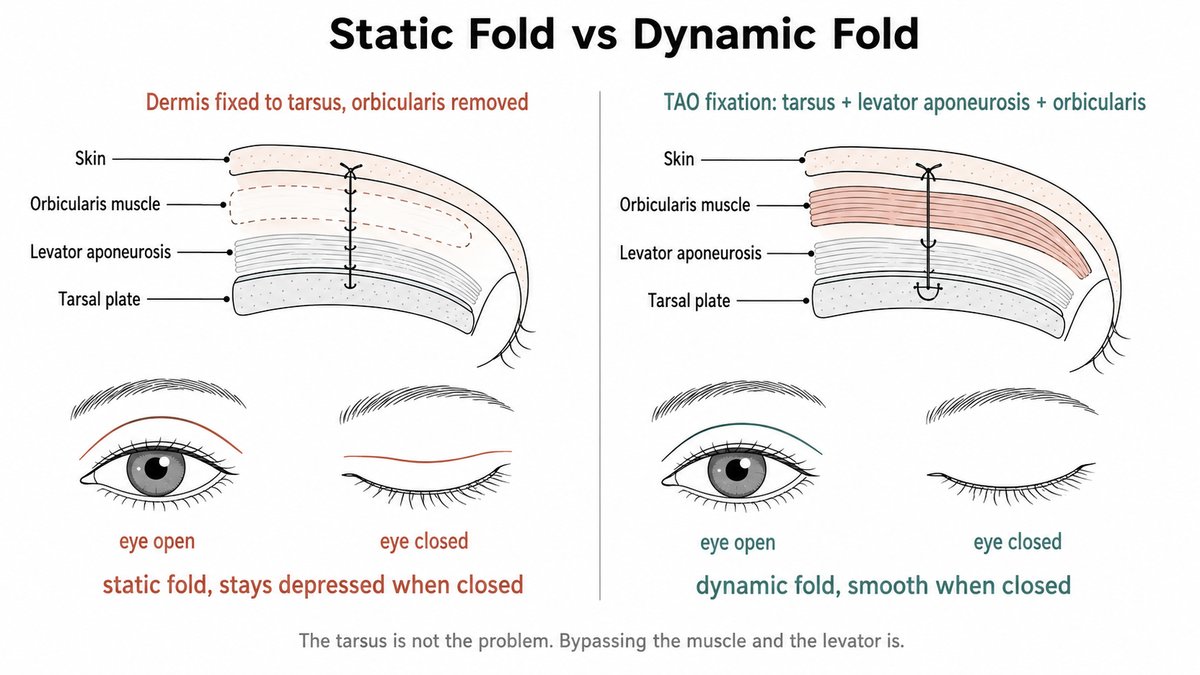 Comparison of a static and a dynamic double eyelid fold: on the left the dermis is fixed straight to the tarsus with the orbicularis removed, leaving a line that stays depressed when the eye closes, and on the right a TAO fixation through the orbicularis, levator aponeurosis, and tarsus leaves the lid smooth when closed.