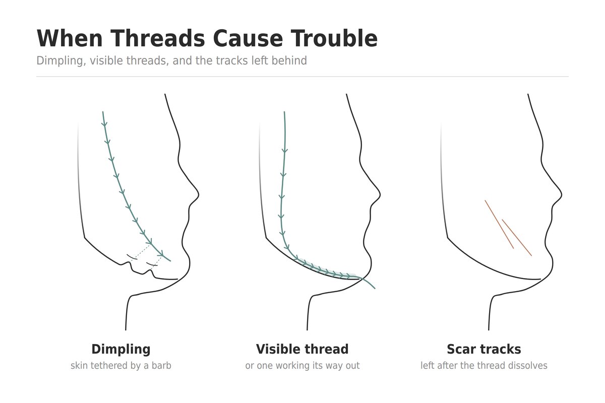 Three-panel diagram of the common late problems after a thread lift: a visible thread outline and dimpled skin tethering along the cheek, a barbed suture migrating with its end palpable near the jaw, and fine linear scar tissue tracks left in the subcutaneous layer after the threads dissolve.